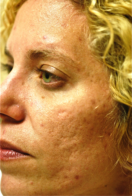 Acne Scars Treatment Before Photo