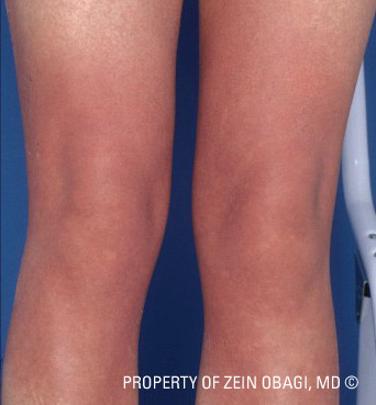 Hyperpigmentation Case 3106 After Photo Hyperpigmentation