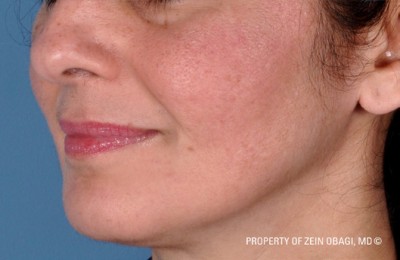 Rosacea