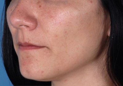 Rosacea