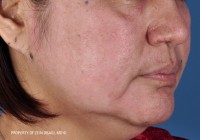 Hyperpigmentation