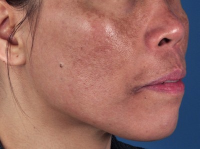 Melasma