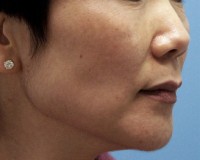 Melasma