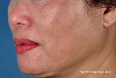 Melasma