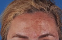 Melasma