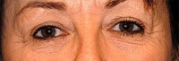 Laser EyeLid Lift