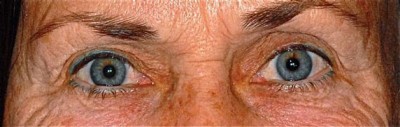 Laser EyeLid Lift Case 3159 Before Photo Laser EyeLid Lift