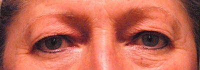 Laser EyeLid Lift