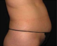 Cellulite Treatment