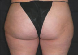 Cellulite Treatment Case 3209 After Photo Cellulite Treatment