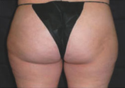 Cellulite Treatment