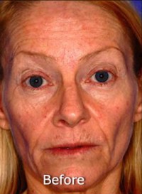 Active FX™ Laser Skin Tightening