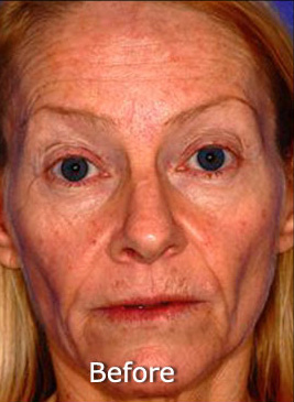 Active FX™ Laser Skin Tightening