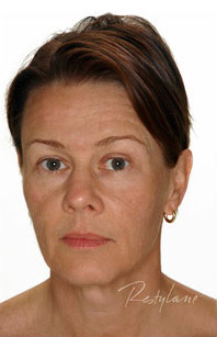 Restylane Case 3283 After Photo Restylane