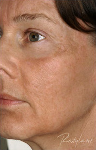 Restylane Case 3283 Before Photo Restylane