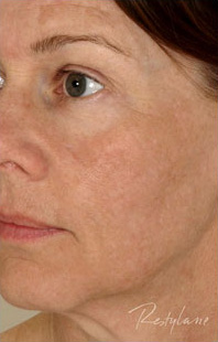 Restylane Case 3283 After Photo Restylane