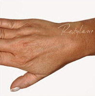 Restylane Case 3314 Before Photo Restylane