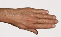 Restylane Case 3325 Before Photo Restylane