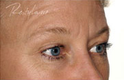 Restylane Case 3339 Before Photo Restylane