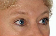 Restylane Case 3339 After Photo Restylane