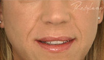 Restylane Case 3343 Before Photo Restylane