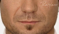 Restylane Case 3347 Before Photo Restylane