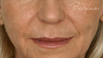 Restylane Case 3351 Before Photo Restylane