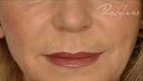 Restylane Case 3351 After Photo Restylane