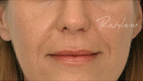 Restylane Case 3355 Before Photo Restylane