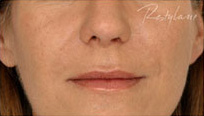 Restylane Case 3355 After Photo Restylane