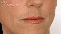 Restylane Case 3359 Before Photo Restylane