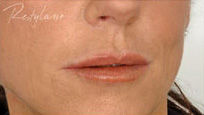 Restylane Case 3359 After Photo Restylane