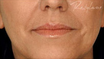 Restylane Case 3367 Before Photo Restylane