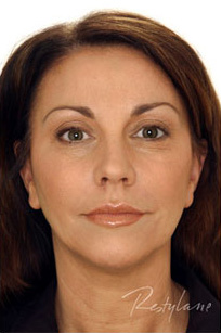 Restylane Case 3375 After Photo Restylane