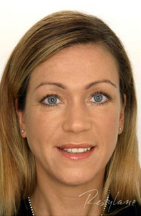 Restylane Case 3379 After Photo Restylane