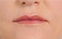 Juvederm