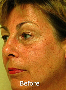 Photo Facial™ Case 3201 Before Photo Photo Facial™