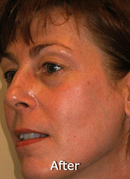 Photo Facial™ Case 3201 After Photo Photo Facial™