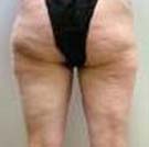 VelaShape Case 3507 Before Photo VelaShape