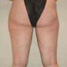 VelaShape Case 3507 After Photo VelaShape