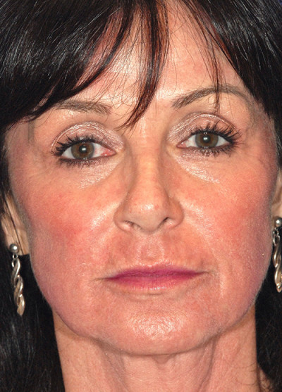 Active FX™ Laser Skin Tightening Case 3163 After Photo Active FX™ Laser Skin Tightening