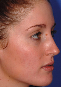 Acne & Acne Scar Laser Treatment