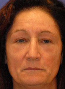 Obagi Blue Peel Result Scottsdale