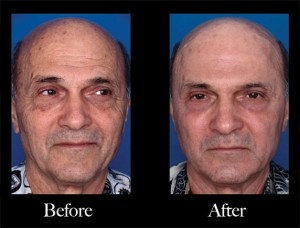 Obagi Blue Peel Result Scottsdale