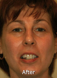 Photofacial IPL BBL treatment for face rejuvenation at Sensational Skin in Scottsdale