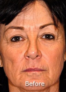 Woman with visible face lines, Laser Resurfacing, Scottsdale AZ