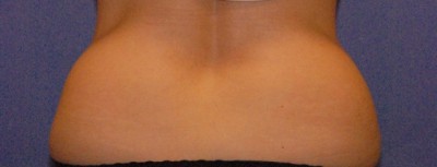 Coolsculpting Case 4140 Before Photo Coolsculpting