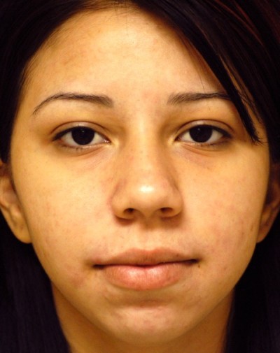 Acne & Acne Scar Laser Treatment Case 4053 After Photo Acne & Acne Scar Laser Treatment