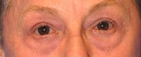 Laser EyeLid Lift