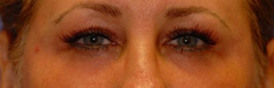 Laser EyeLid Lift Case 4071 After Photo Laser EyeLid Lift